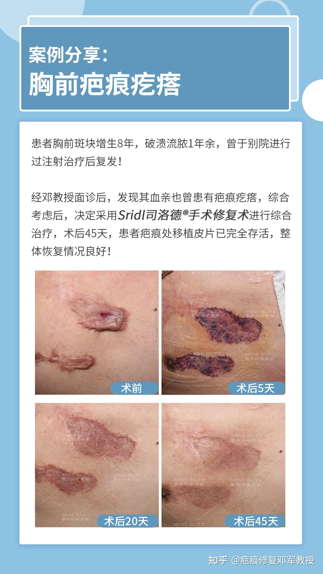 疤痕最新研究进展与治疗进展，探索最新治疗方法和策略